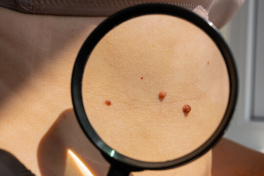 Sun exposure effects and skin check for melanoma