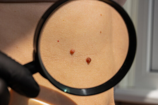 Birthmarks and skin health awareness concept