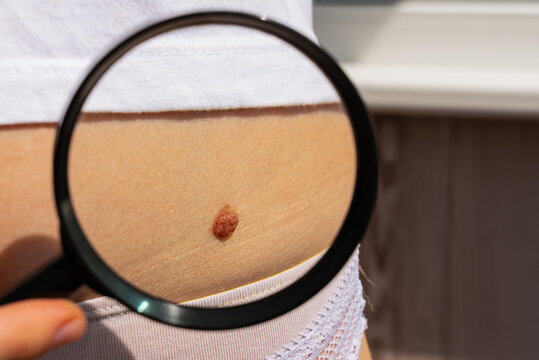 Birthmarks and sun exposure effect on skin