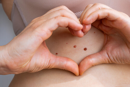 Birthmarks and skin health awareness concept