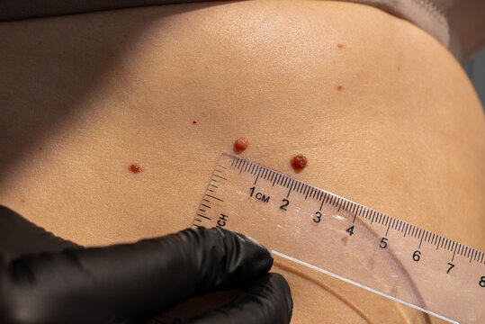 Birthmarks and sun exposure effects on skin