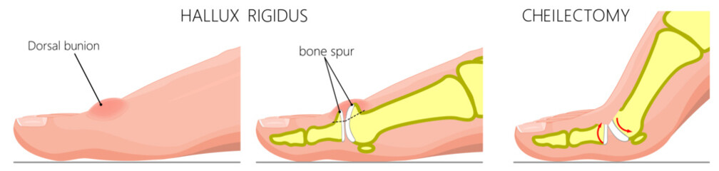Hallux rigidus cheilectomy. Close up view