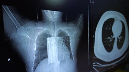 A detailed view of a medical monitor displaying chest X-ray and CT scan, suggesting an enlarged inspection of the lung tissue. - Powered by Adobe