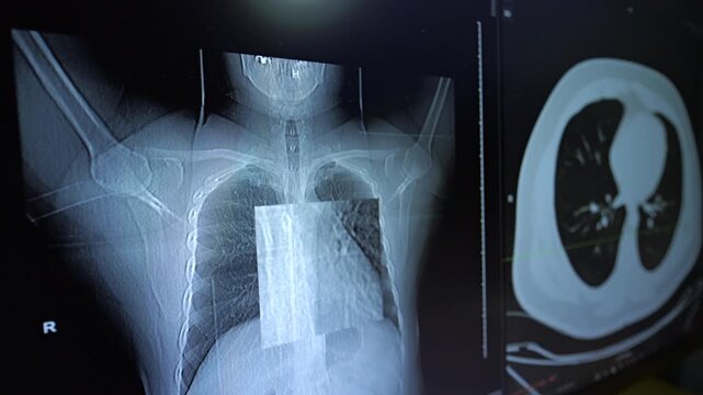A detailed view of a medical monitor displaying chest X-ray and CT scan, suggesting an enlarged inspection of the lung tissue.