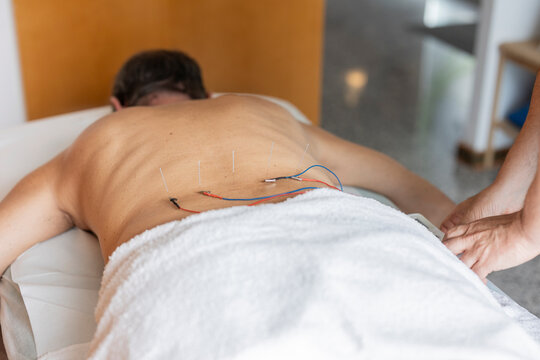 Acupuncture therapy session with electroacupuncture on back at clinic