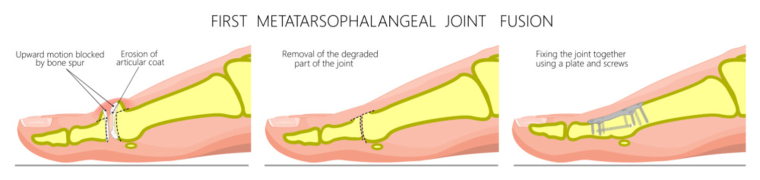 Hallux rigidus traetment. Joint fusion using a plate and screws