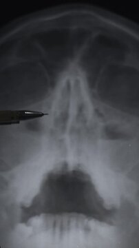 Doctor learning vertical medical X-ray of head Injury. Deviated Nasal Septum. Nose trauma.