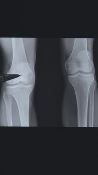 Doctor learn vertical X-ray of dysplastic coxarthrosis. Deformation of the left femoral head. Aseptic necrosis, massive cystic changes in the hip joint. Shortening of the left lower limb by 4.0 cm.