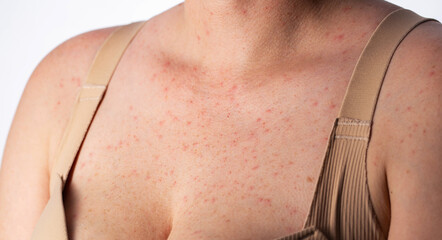 Red pimples and rashes on the skin of a woman's chest, close-up, allergic reaction to medication, dermatology