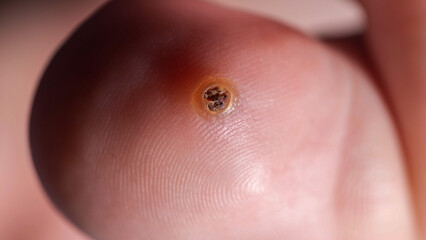 Close-Up Of A Painful Plantar Wart. The Photo Focuses On The Infected Skin On The finger legs.