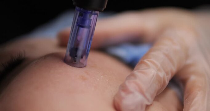 Woman receives cosmetic facial treatments. Microneedling for facial skin. Restoration and rejuvenation of female beauty and health. Beauty business.