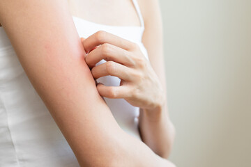 Dermatology, asian young woman reaction from atopic, insect bites on her arm, hand in scratching itchy red spot or rash of skin. Healthcare, treatment of beauty.