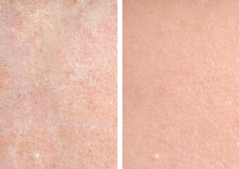 Fototapeta premium Dry skin before and after moisturizing, marco view. Collage for comparison