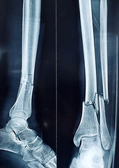 Distal Tibia and Fibula Comminuted Fracture X-Ray 