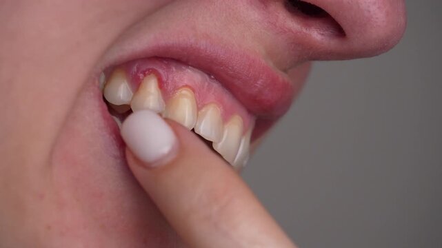 Close-up of irritated gum tissue with visible redness and swelling while lifting the lip. Ideal for dental education, oral disease awareness, periodontal issues and medical illustration use.