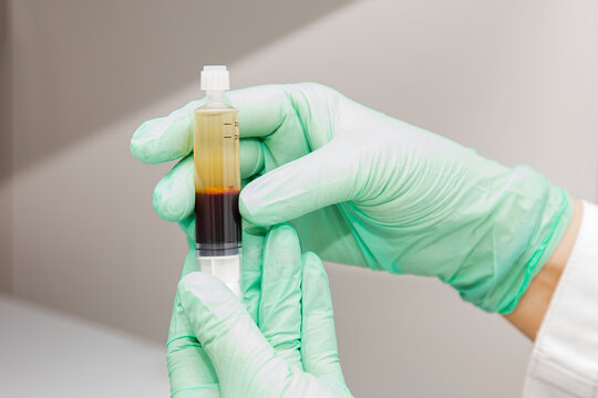 A cosmetologist in a white coat and gloves checks and demonstrates a blood collection tube with centrifuged blood - separated rich in platelets and plasma