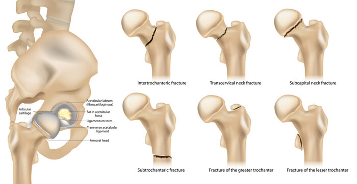Types of Proximal Femur Fractures. Hip Fracture Types by Anatomical Location. Medical Diagram