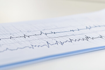 ECG electrocardiogram