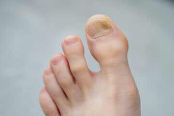 Detailed look at big toe with nail discoloration and rough surface texture providing clear...