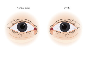 Detailed diagram showing normal eye structure versus uveitis-related ocular inflammation