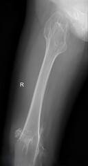 Osteochondroma  and  Multiple Hereditary Exostosis x ray 
