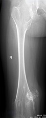 Osteochondroma  and  Multiple Hereditary Exostosis x ray 