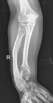 Osteochondroma  and  Multiple Hereditary Exostosis x ray 