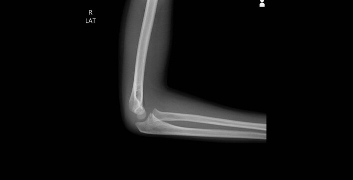 Elbow x-ray showing humerus, radius, ulna and joint. Lateral view plain film radiograph for diagnostic examination of elbow bone structure and articulation anatomy