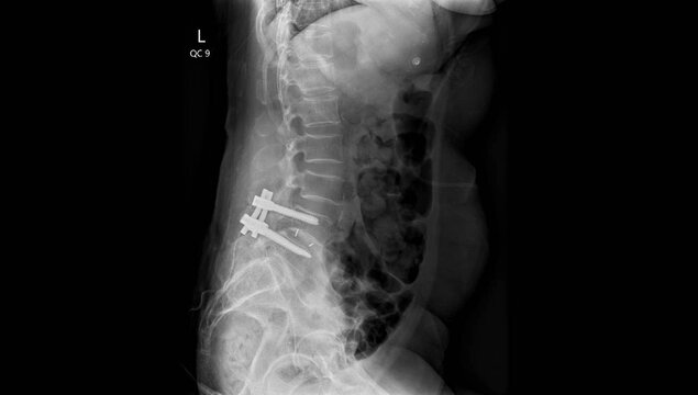 x-ray showing lumbar spine with surgical fixation hardware. Lateral view radiograph for postoperative examination of spine instrumentation and abdomen
