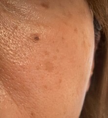 50代女性のリアルな肌。シミ、肝斑、毛穴、シワ、たるみ。