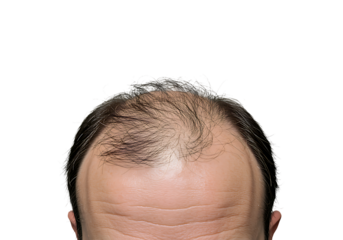 Male head top view showing receding hairline and sparse hair on transparent background.