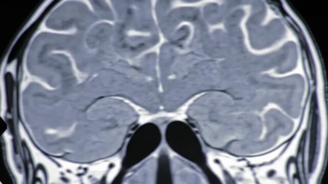Detailed anterior view of a coronal section of human brain in white background showcases intricate cerebral anatomy, structure, and medical detail on image.