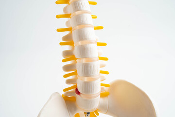 Spinal nerve and bone, Lumbar spine displaced herniated disc fragment, Model for treatment medical in the orthopedic department.