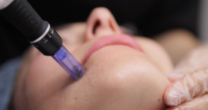 Woman receives cosmetic facial treatments. Microneedling for facial skin. Restoration and rejuvenation of female beauty and health. Beauty business.
