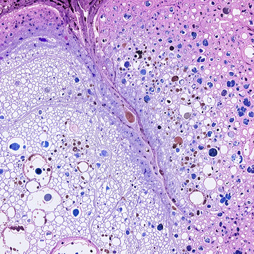 Histological biopsy of Scrotal wall under microscopy showing Calcinosis cutis. Scrotal calcinosis. Calcinosis cutis of scrotum