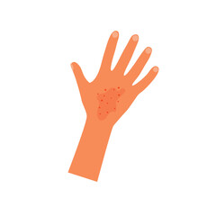 Rash on hand and arm skin, isolated medical icon