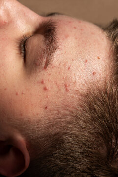 The forehead of a teenager with pronounced acne, vertical photo.