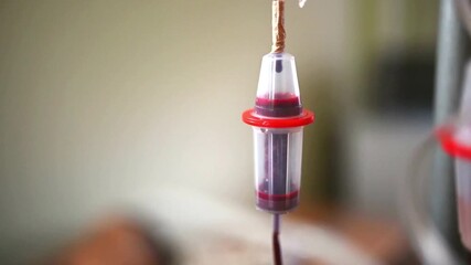 Close-up shot of a medical IV drip chamber filled with blood during a blood donation or transfusion procedure in a hospital or clinical setting. The video highlightsdonor blood collection. - Powered by Adobe