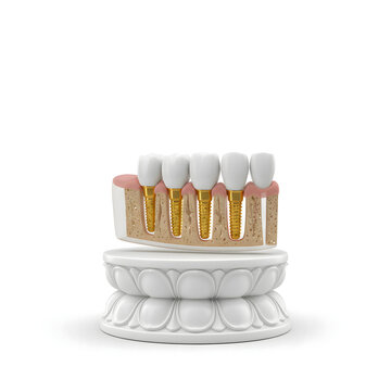 3D realistic medical illustration of dental implants in a jawbone
