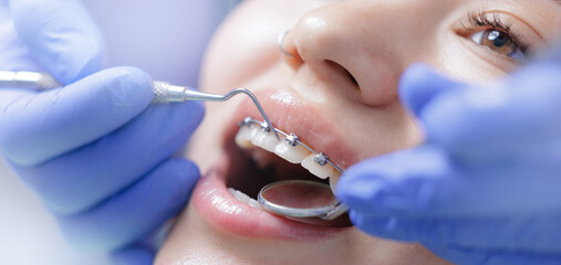 Asian female receiving orthodontic treatment with braces close-up, banner orthodontic