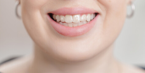 Close-up of female adult caucasian smiling with crooked teeth and pink lips
