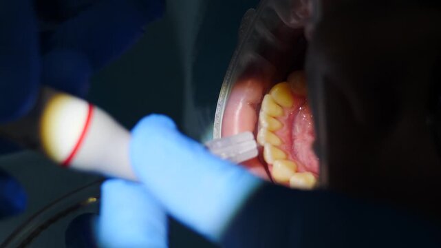 Dentist performs hygienic cleaning teeth in dentistry for patient. Real footage of professional dentist cleaning teeth from plaque and calculus with electric tool using strong jet of water close-up