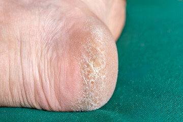 Fototapeta premium A close up of a person's foot with a fungus on it