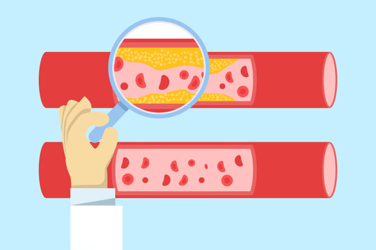 illustration of cardiovascular system analysis, showing cholesterol buildup, blood clots in veins and arteries, and medical study of heart health, circulation, and cardiology examination.