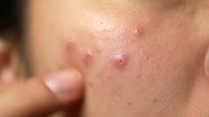 Close-up Macro Shot of Acne on Skin, a Person Touching a Pimple, Concept of Skin Care and Dermatology, Animation 4k