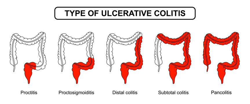 Illustration types of ulcerative colitis. Inflammation of the human digestive system. Inflammatory bowel disease, Inflammation of the human digestive system. Vector drawing illustration for medical
