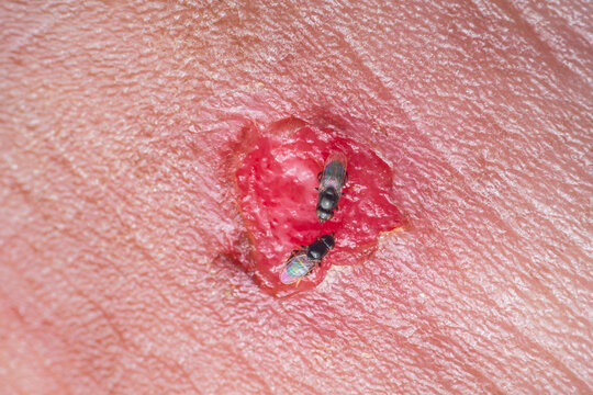 Flies feeding on festering wound on human skin