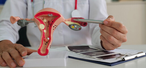 Gynecologist points with pen to anatomical model of uterus and ovaries