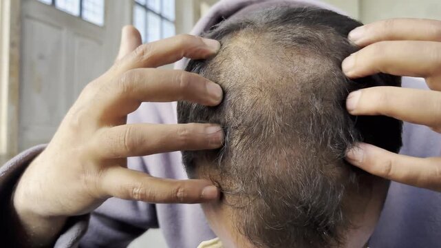 Closeup footage of a young boy showing his head hairfall scalp. Hairfall is increasing in young generation due to life style change and depression. A young boy showing his bald scalp as hairfall.