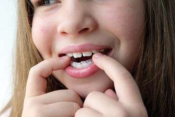 Close up of young girl carefully putting on clear dental aligners, showing modern orthodontic care...